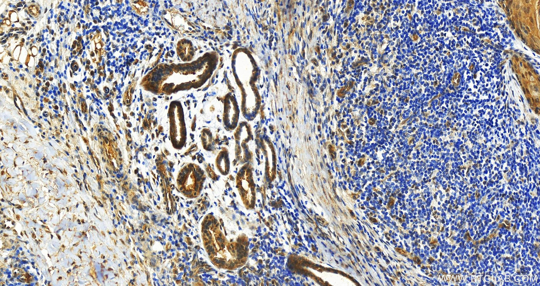 IHC staining of human skin cancer using 68641-1-Ig