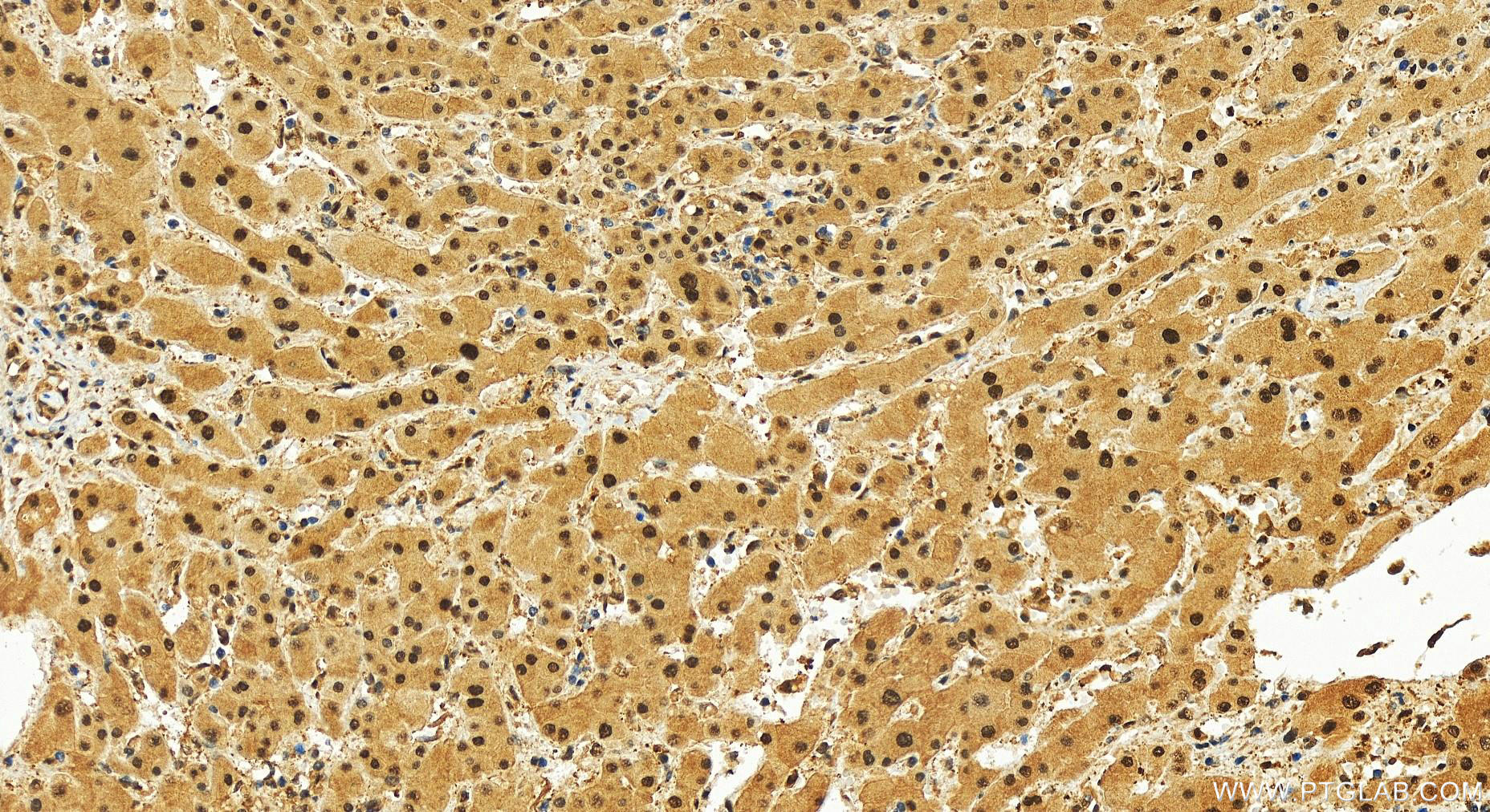 IHC staining of human intrahepatic cholangiocarcinoma using 83521-2-RR (same clone as 83521-2-PBS)