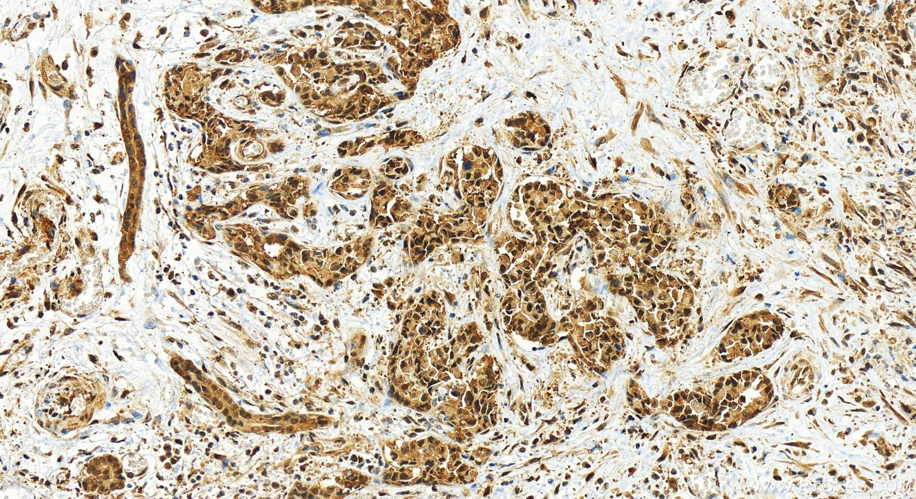 IHC staining of human intrahepatic cholangiocarcinoma using 83521-2-RR (same clone as 83521-2-PBS)