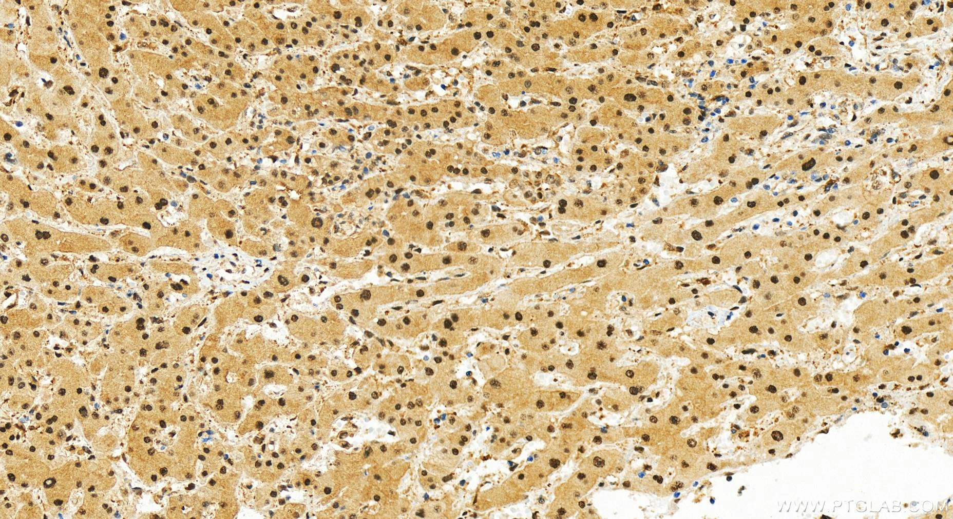 IHC staining of human intrahepatic cholangiocarcinoma using 83521-4-RR (same clone as 83521-4-PBS)