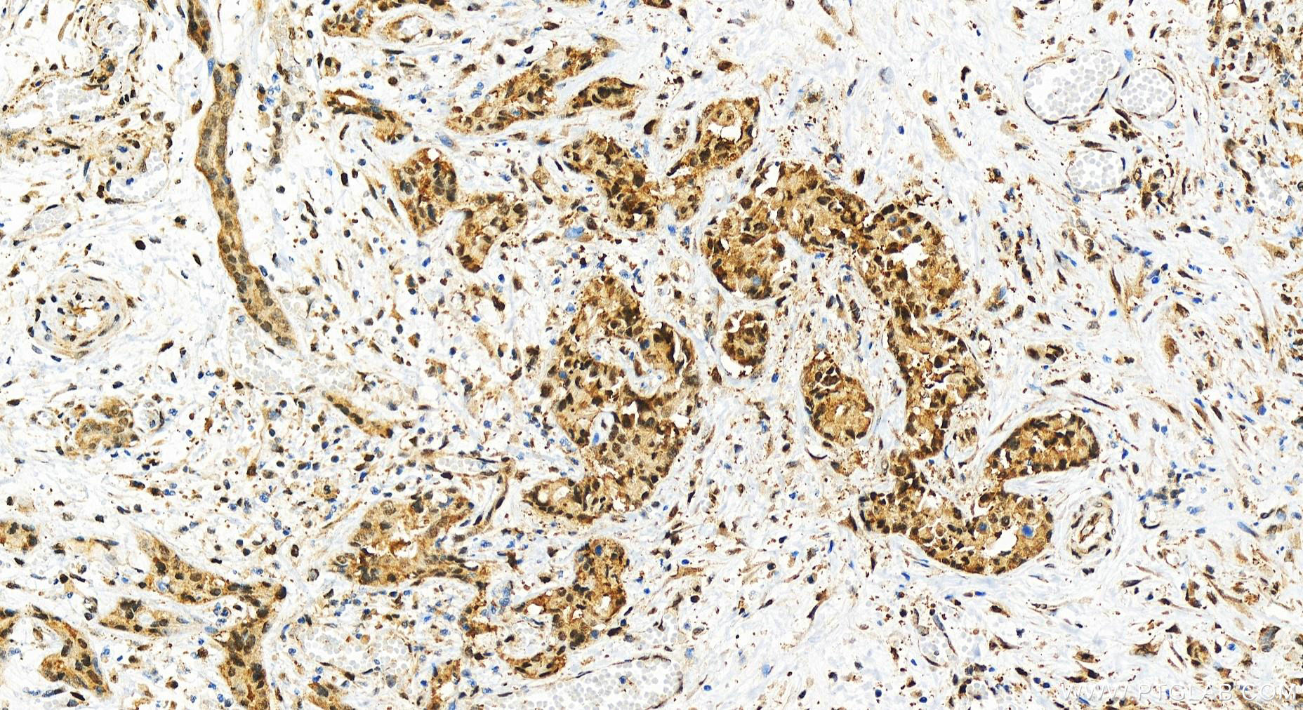 IHC staining of human intrahepatic cholangiocarcinoma using 83521-4-RR