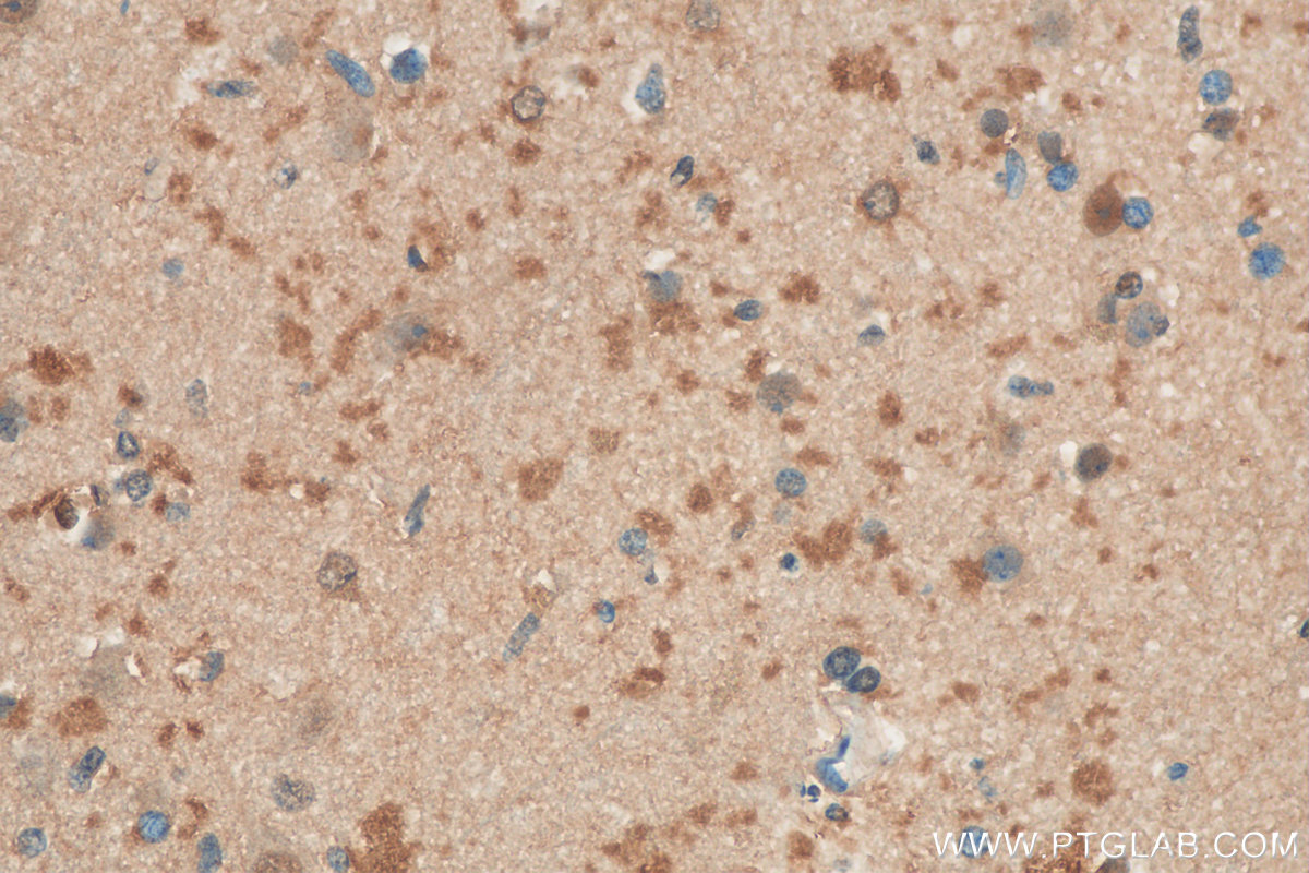 IHC staining of human gliomas using 11412-1-AP (same clone as 11412-1-PBS)