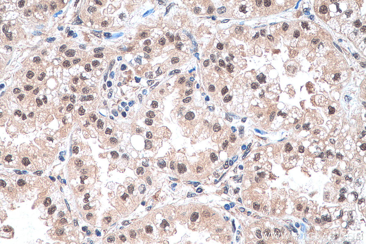 IHC staining of human lung cancer using 67807-1-Ig