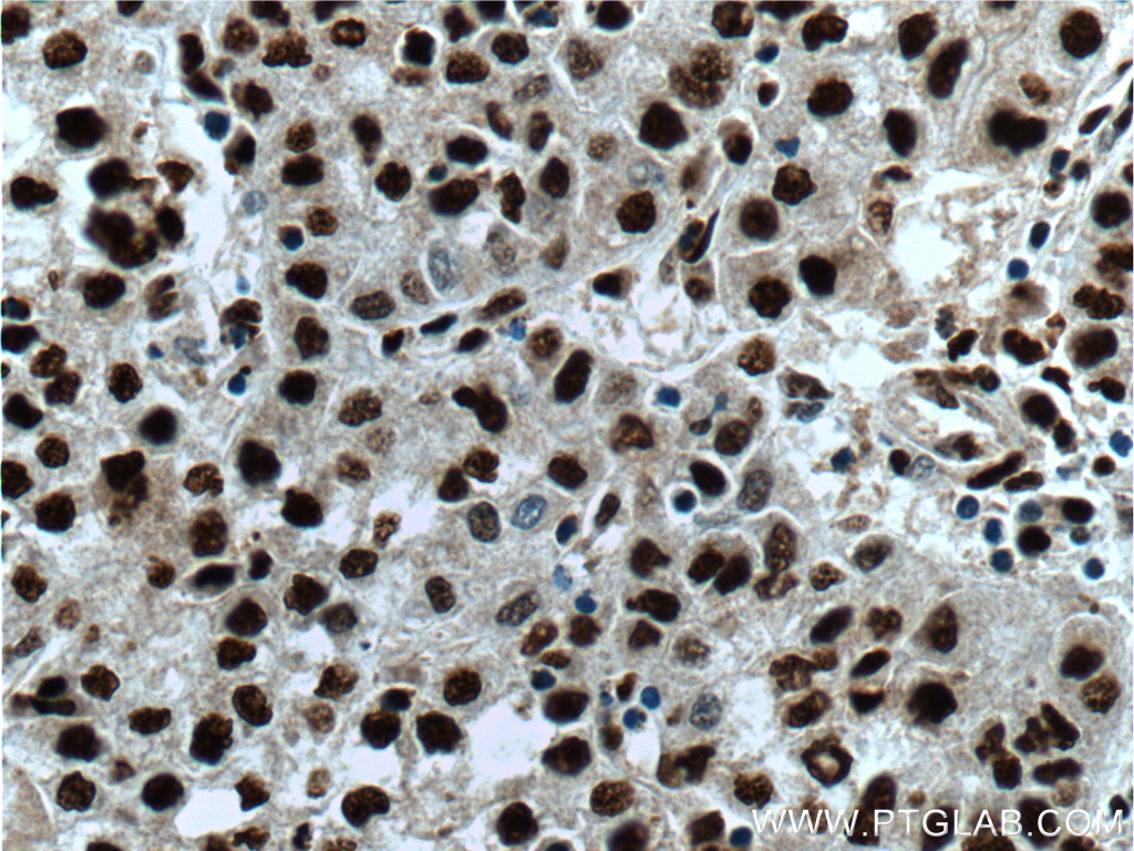 IHC staining of human liver cancer using 18799-1-AP