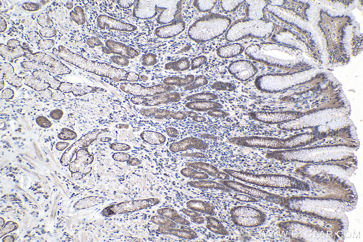 IHC staining of human stomach cancer using 10335-1-AP