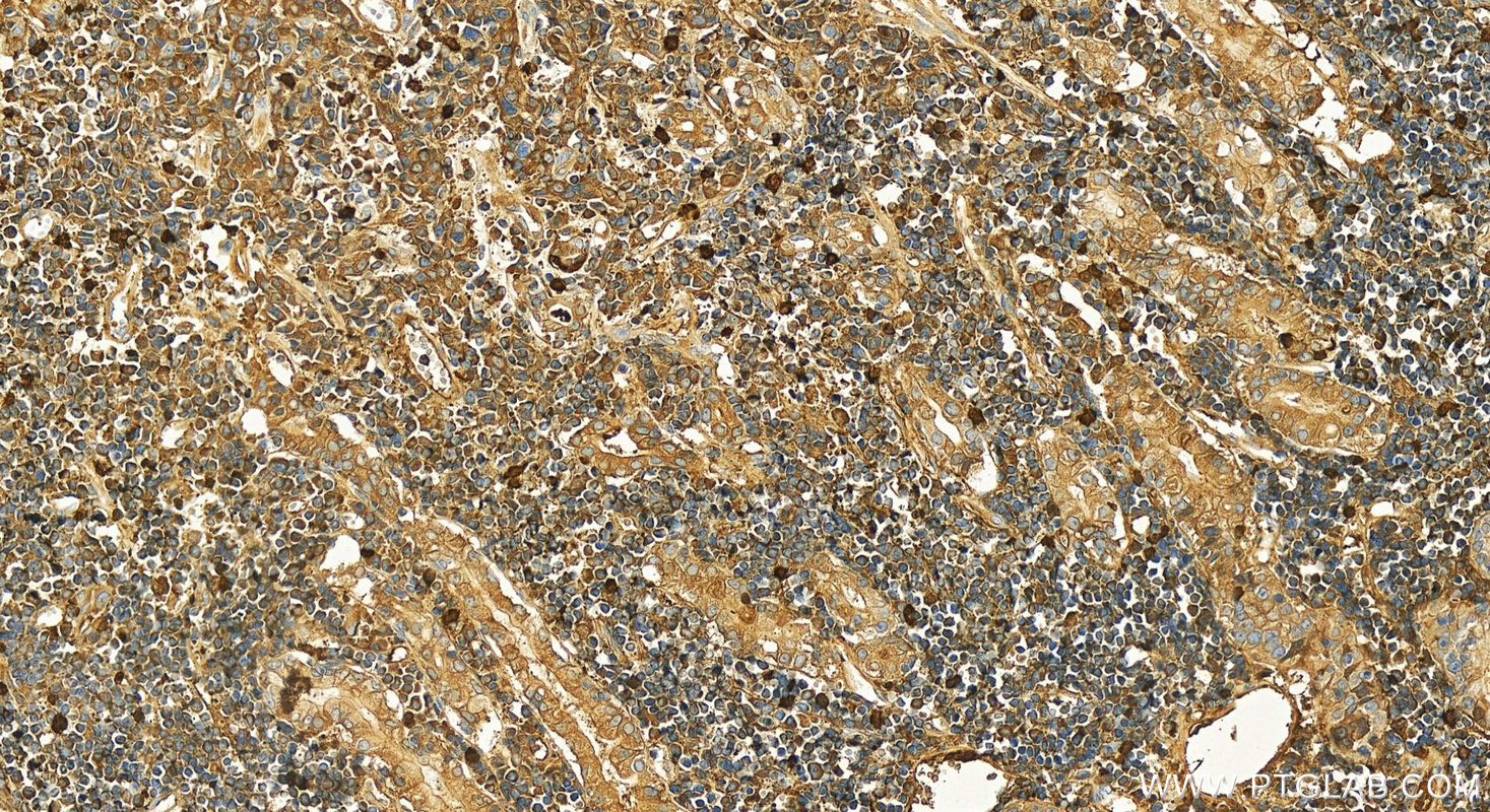 IHC staining of human stomach cancer using 15601-1-AP