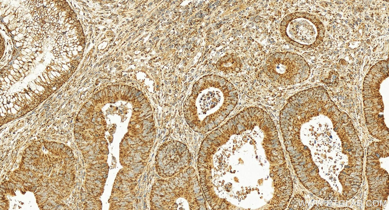 IHC staining of human colon cancer using 10881-1-AP