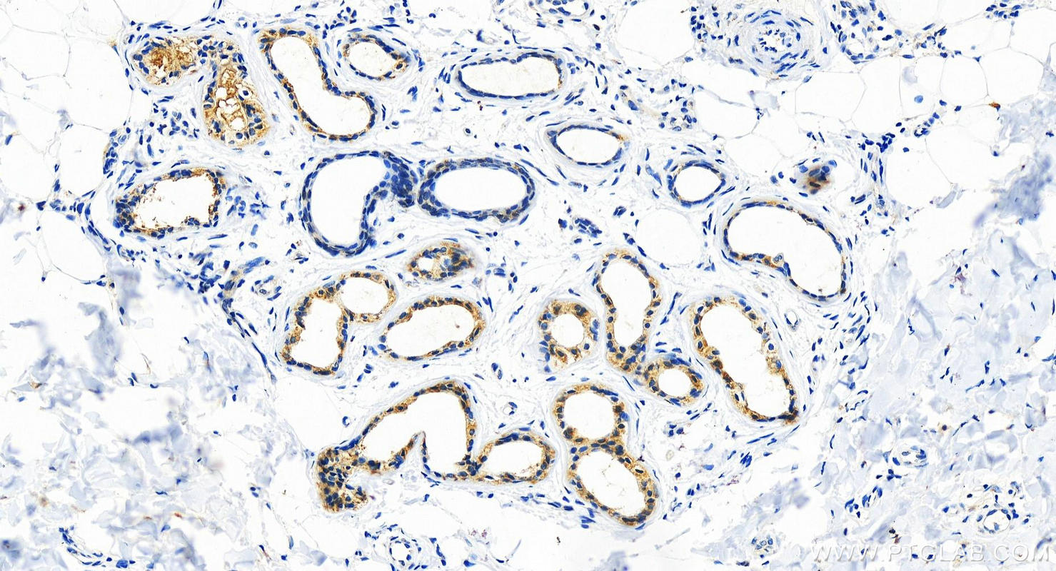 IHC staining of human bowen disease using 12375-1-AP