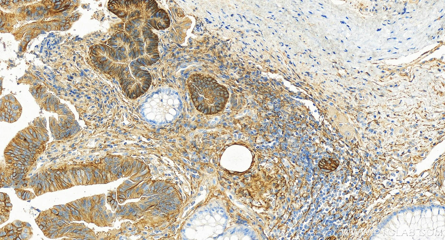 IHC staining of human colon cancer using 17799-1-AP