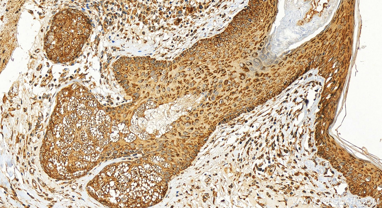 IHC staining of human paracancerous of skin cancer using 20641-1-AP