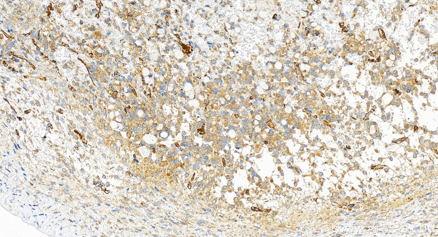 IHC staining of human ovary cancer using 83851-6-RR