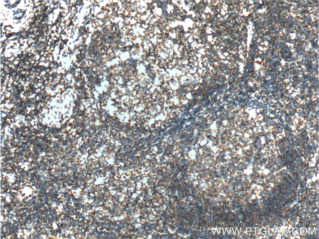 IHC staining of human tonsillitis using 55123-1-AP