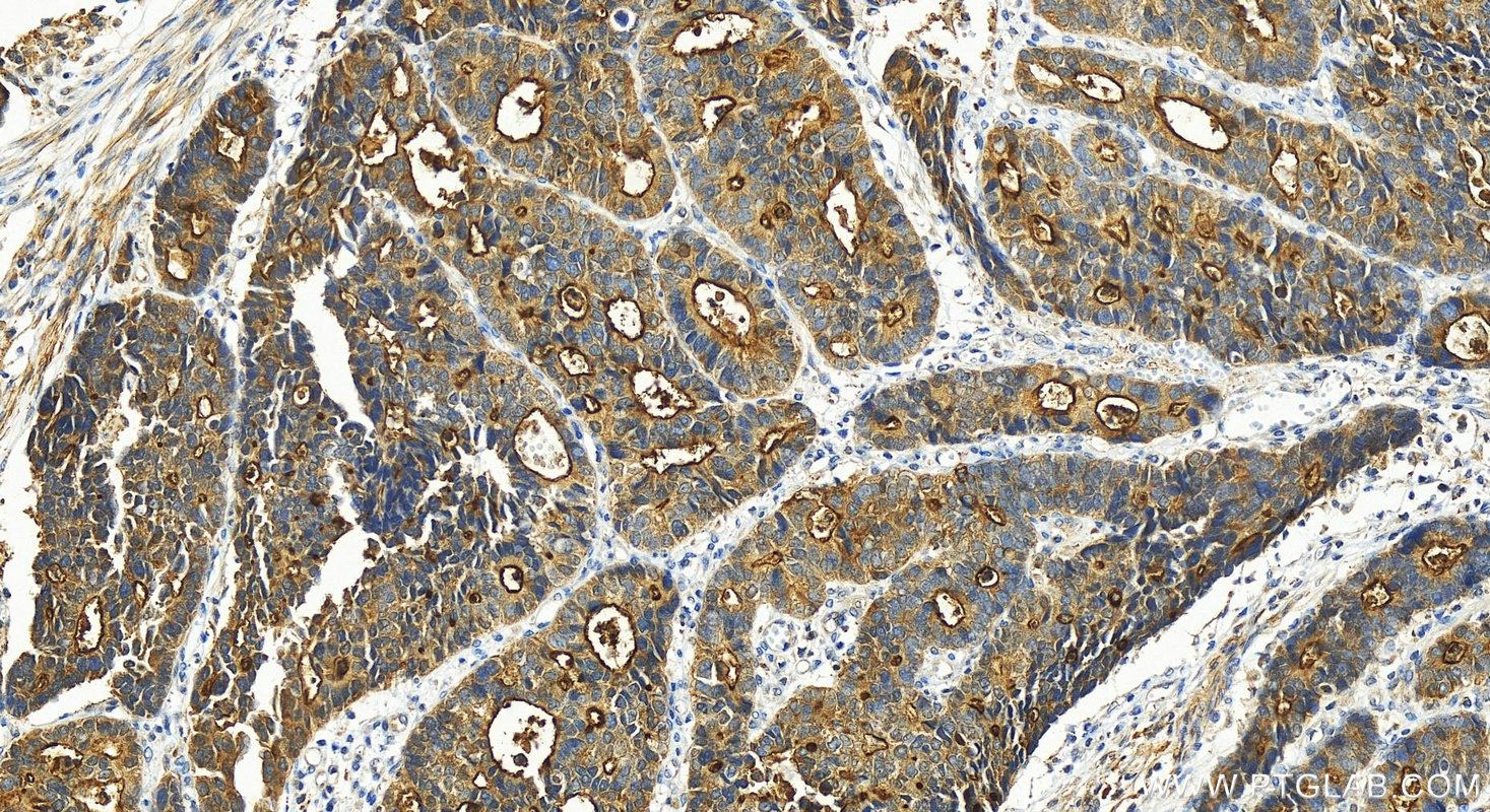 IHC staining of human stomach cancer using 55060-1-AP