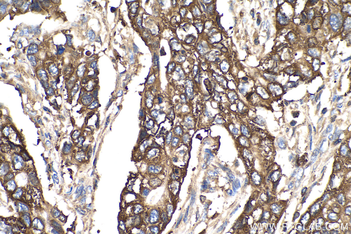 IHC staining of human stomach cancer using 12075-1-AP