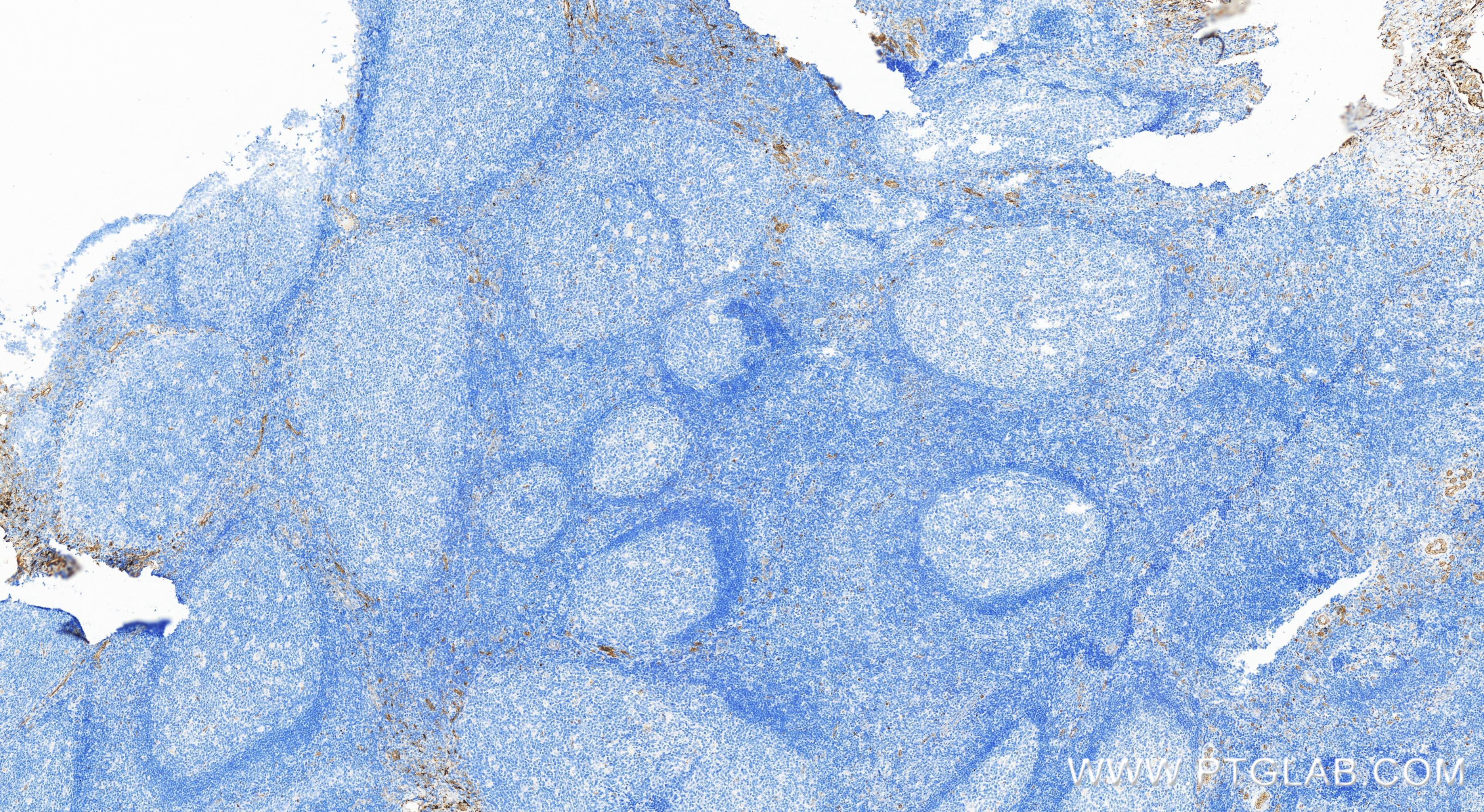 IHC staining of human tonsillitis using 83977-1-RR