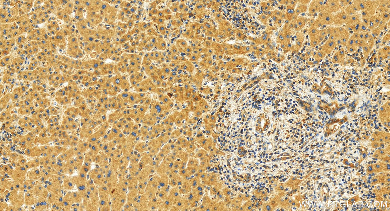 IHC staining of human intrahepatic cholangiocarcinoma using 22271-1-AP