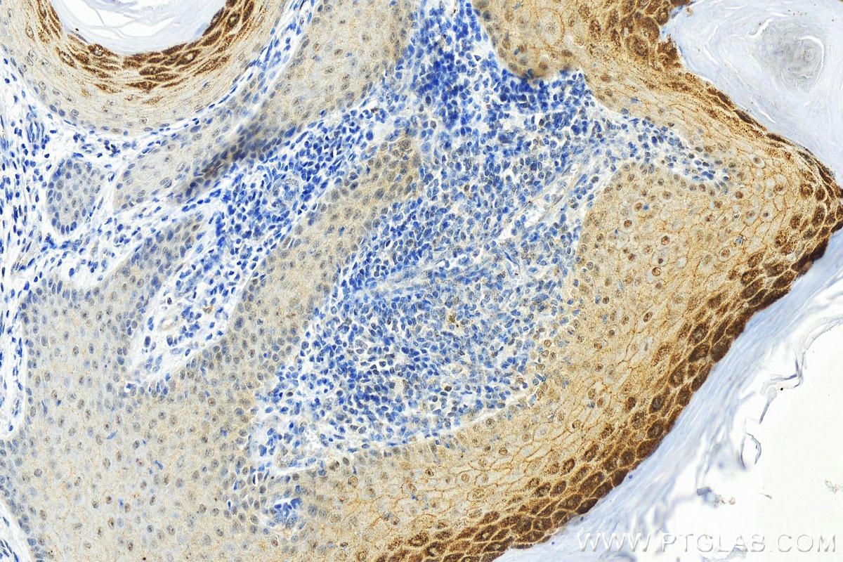 IHC staining of human skin cancer using 82349-1-RR