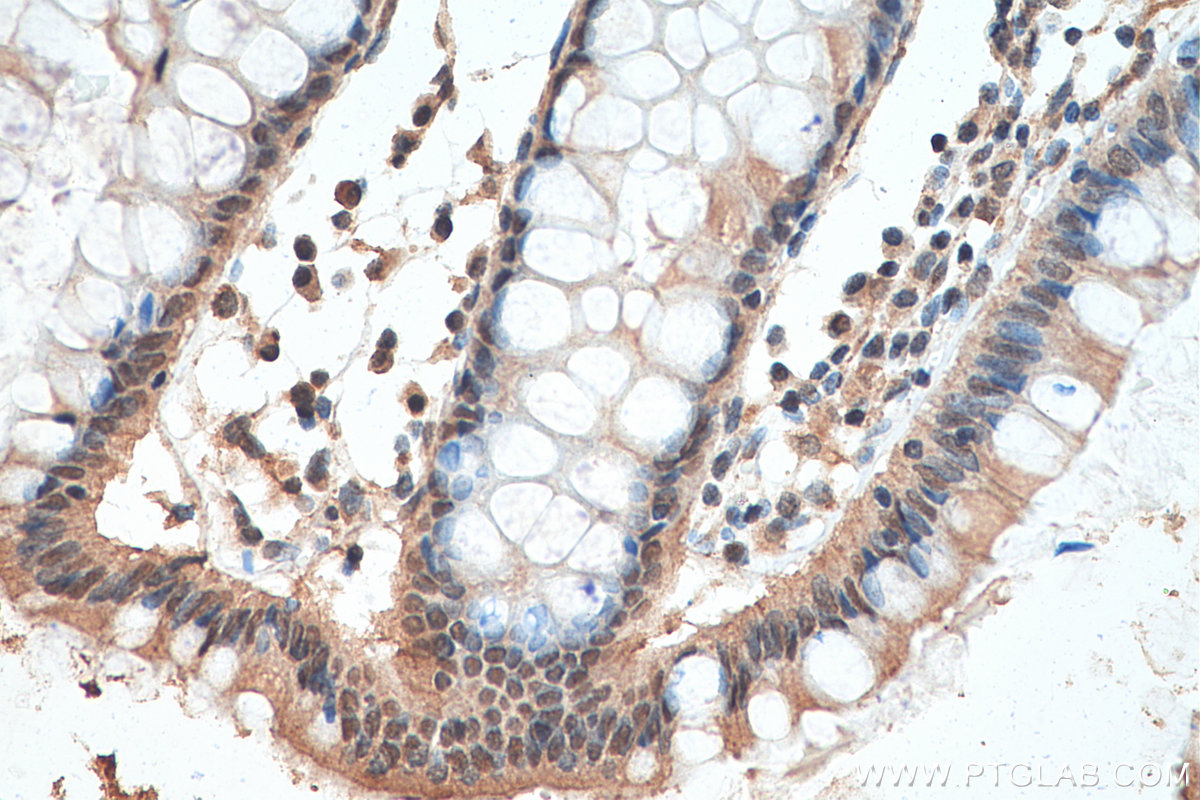 IHC staining of human colon cancer using 67900-1-Ig (same clone as 67900-1-PBS)