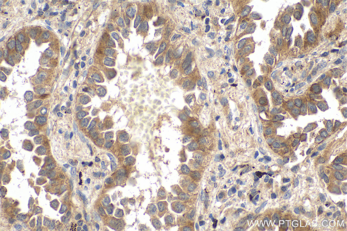 IHC staining of human lung cancer using 55463-1-AP