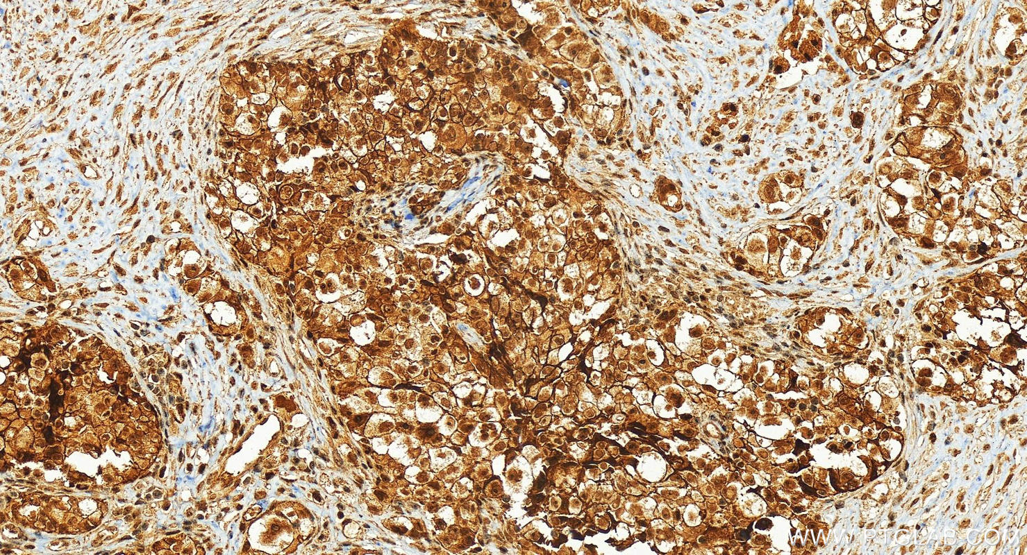 IHC staining of human ovary cancer using 26479-1-AP