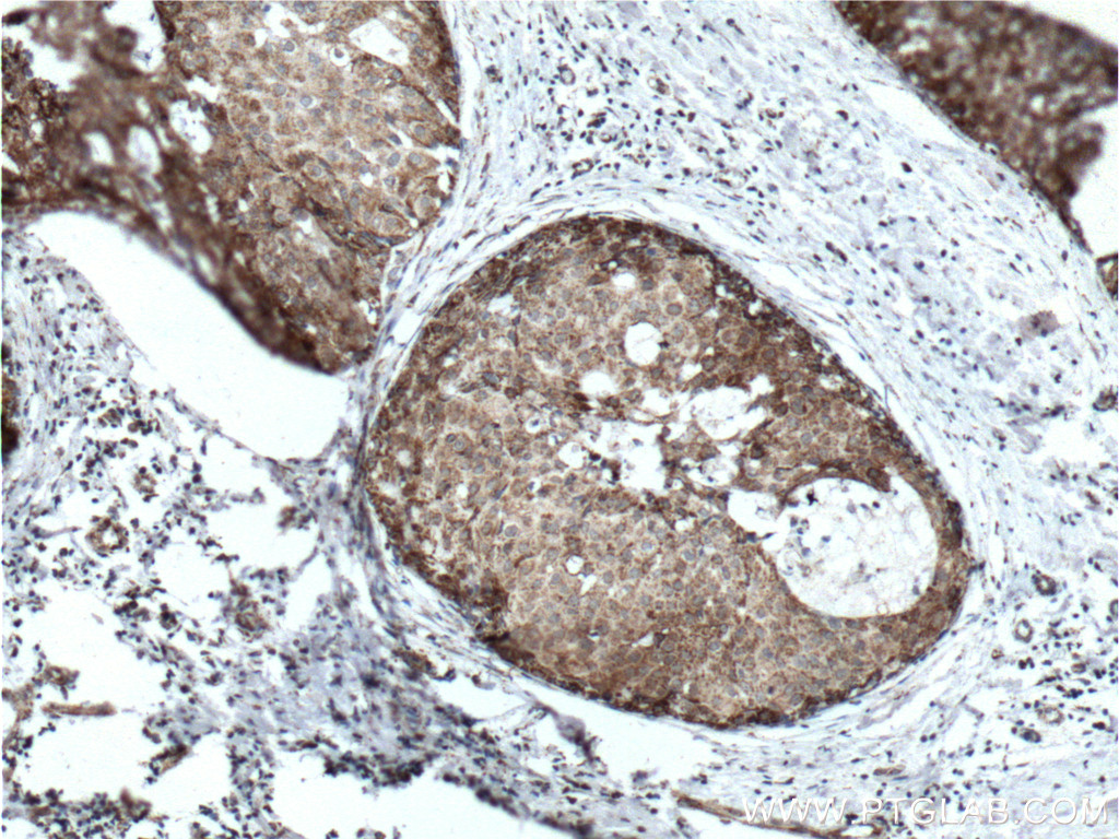 IHC staining of human breast cancer using 66424-1-Ig (same clone as 66424-1-PBS)
