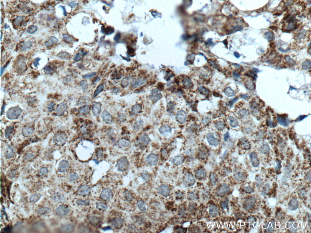 IHC staining of human breast cancer using 66424-1-Ig (same clone as 66424-1-PBS)