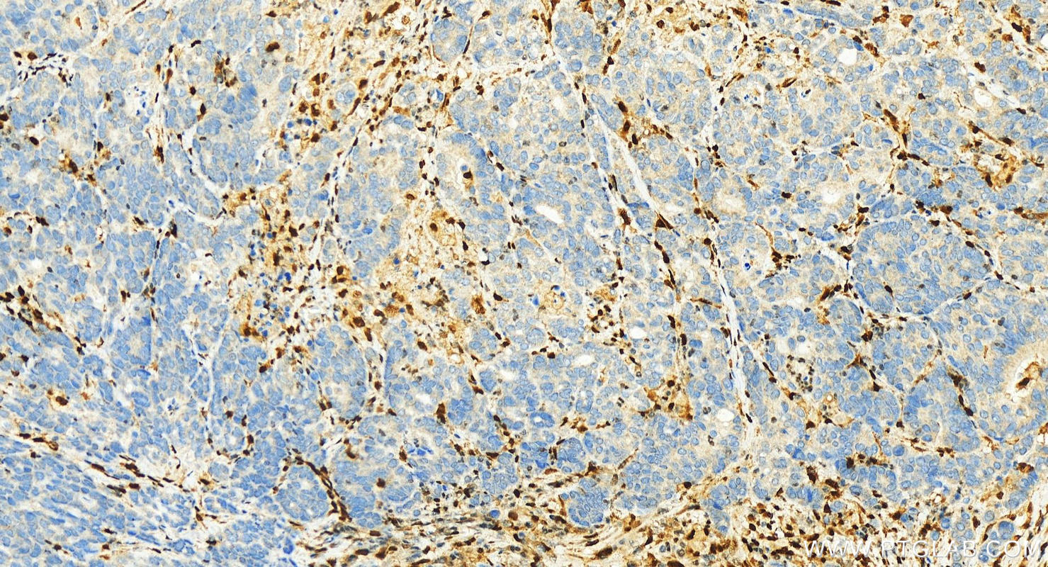 IHC staining of human stomach cancer using 13169-1-AP