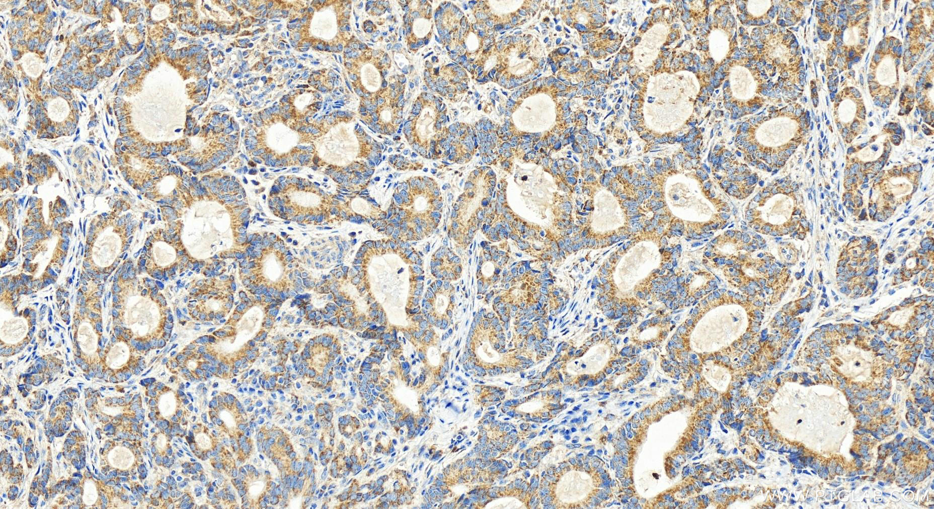 IHC staining of human stomach cancer using 15926-1-AP