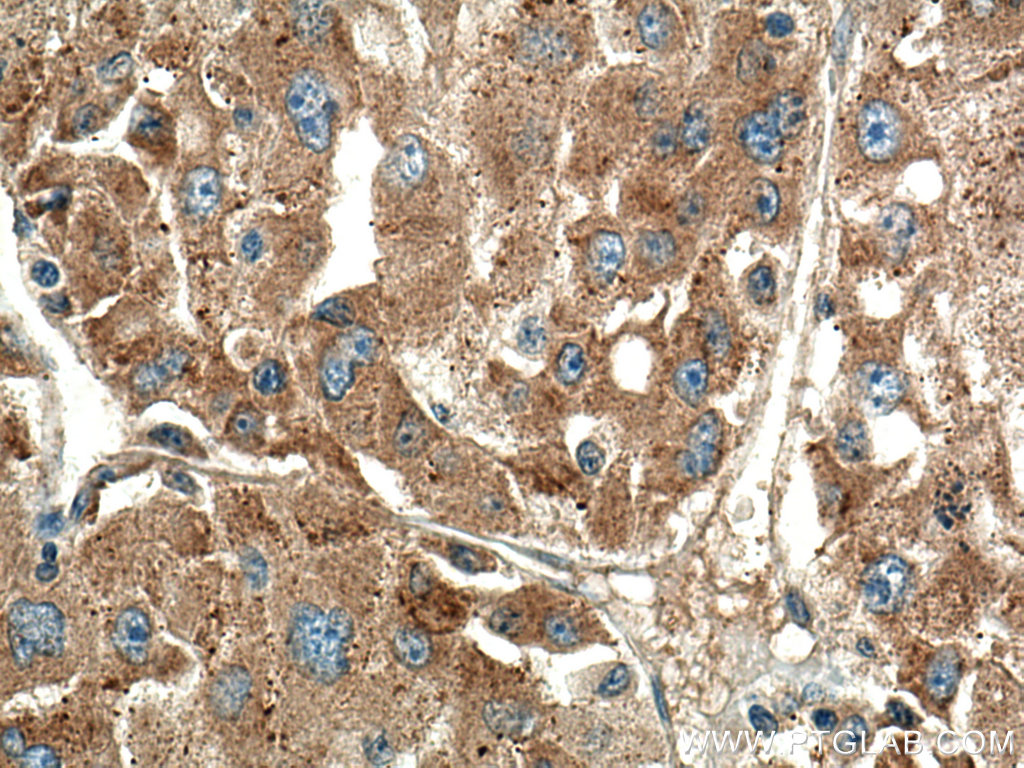 IHC staining of human liver cancer using 11808-1-AP