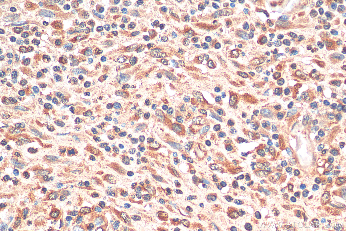 IHC staining of human colon cancer using 67953-1-Ig