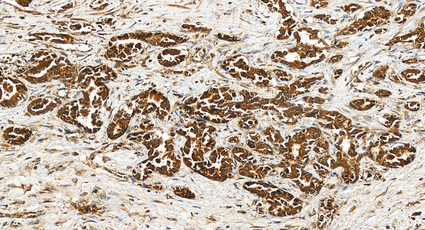 IHC staining of human intrahepatic cholangiocarcinoma using 28274-1-AP