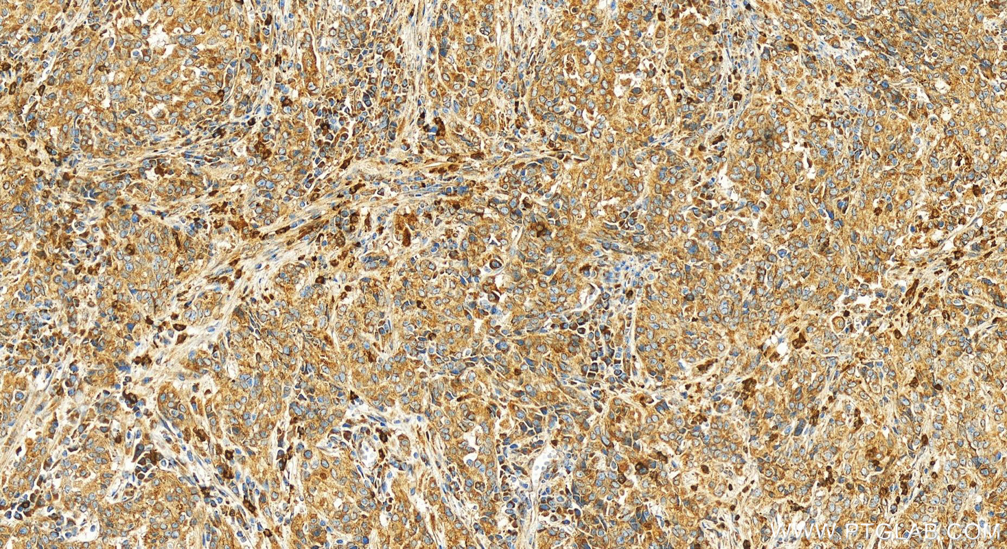 IHC staining of human stomach cancer using 11304-1-AP