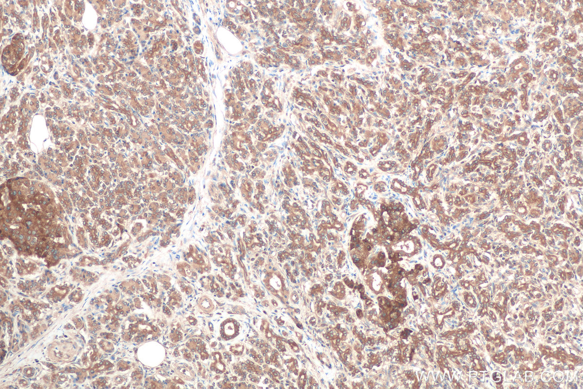 IHC staining of human pancreas cancer using 67837-1-Ig (same clone as 67837-1-PBS)