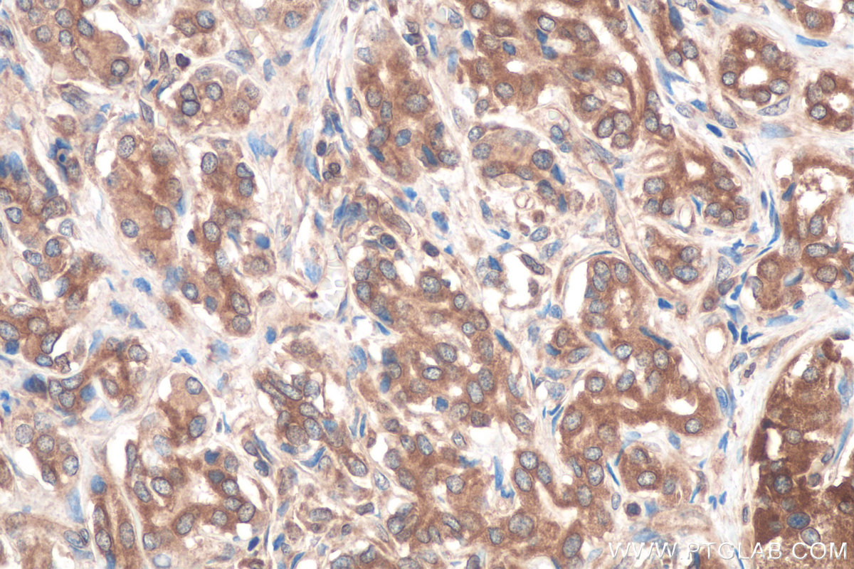 IHC staining of human pancreas cancer using 67837-1-Ig (same clone as 67837-1-PBS)