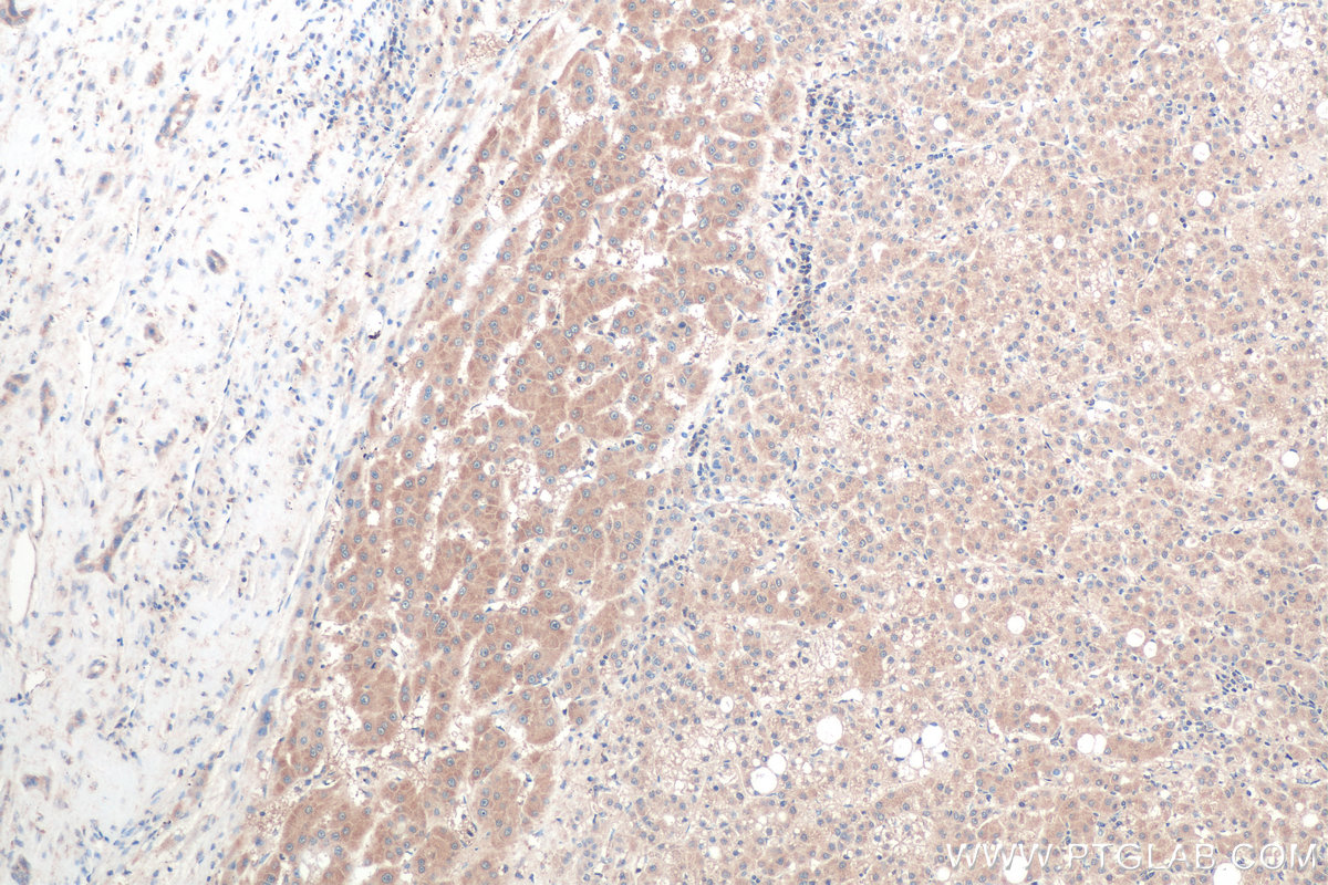 IHC staining of human liver cancer using 67837-1-Ig (same clone as 67837-1-PBS)