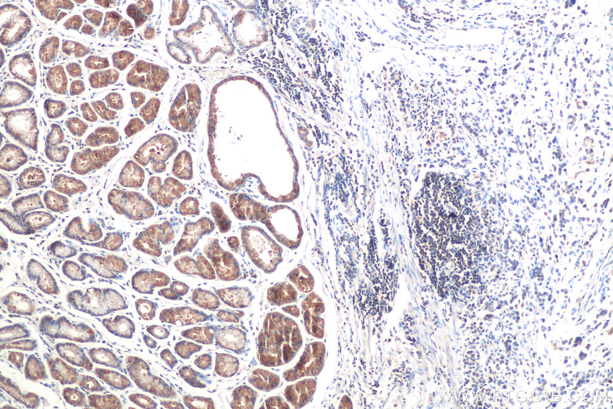 IHC staining of human stomach cancer using 67837-1-Ig (same clone as 67837-1-PBS)