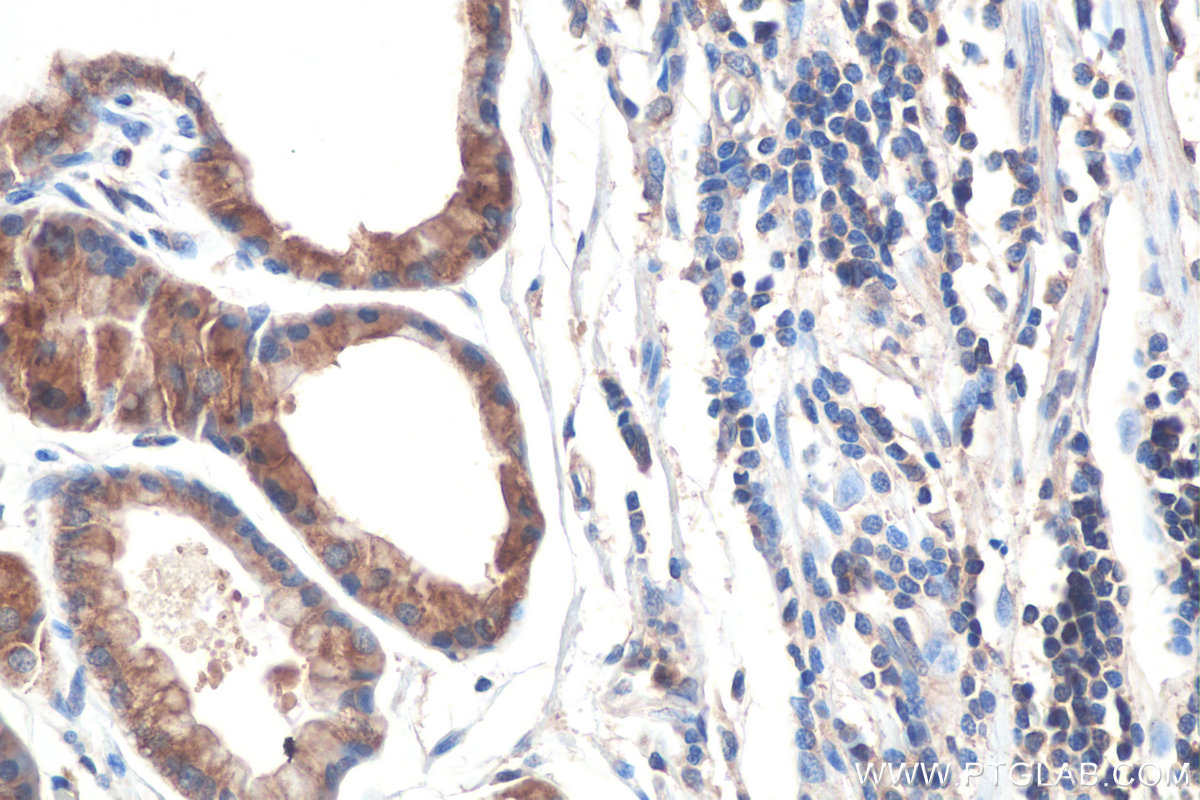 IHC staining of human stomach cancer using 67837-1-Ig (same clone as 67837-1-PBS)