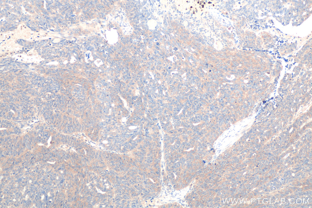 IHC staining of human ovary tumor using 67837-1-Ig (same clone as 67837-1-PBS)