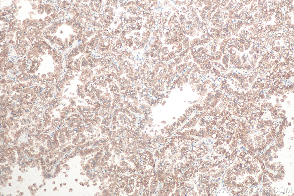 IHC staining of human lung cancer using 67837-1-Ig (same clone as 67837-1-PBS)