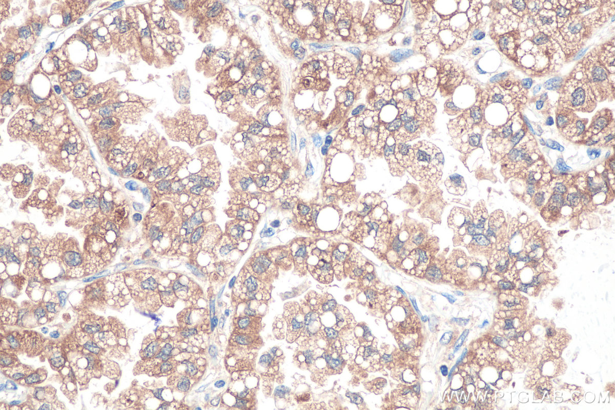 IHC staining of human lung cancer using 67837-1-Ig (same clone as 67837-1-PBS)