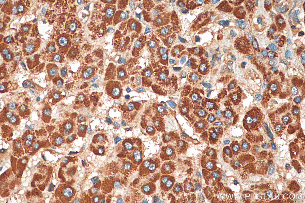 IHC staining of human liver cancer using 29110-1-AP