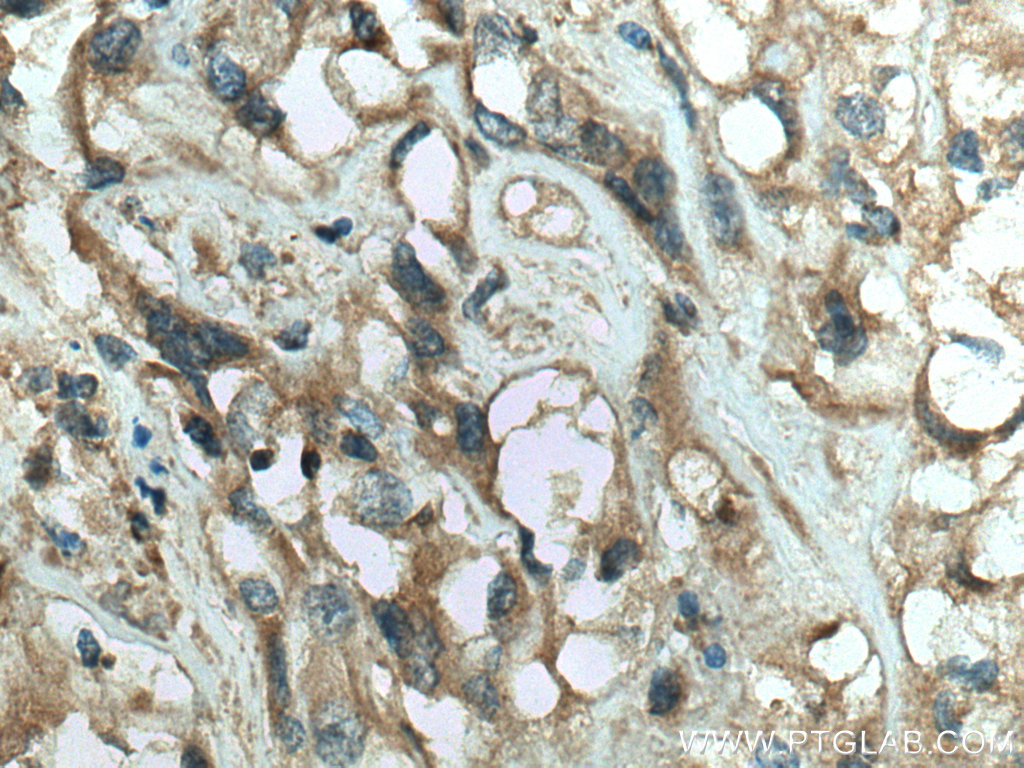 IHC staining of human renal cell carcinoma using 13189-1-AP