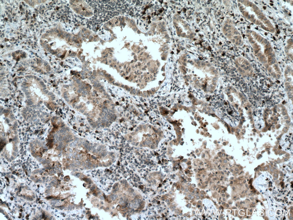 IHC staining of human lung cancer using 66944-1-Ig (same clone as 66944-1-PBS)
