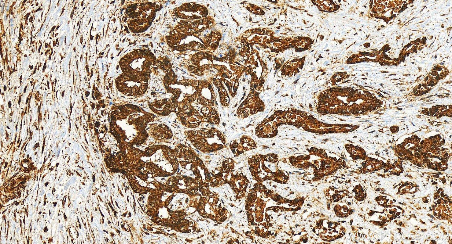 IHC staining of human intrahepatic cholangiocarcinoma using 82960-5-RR