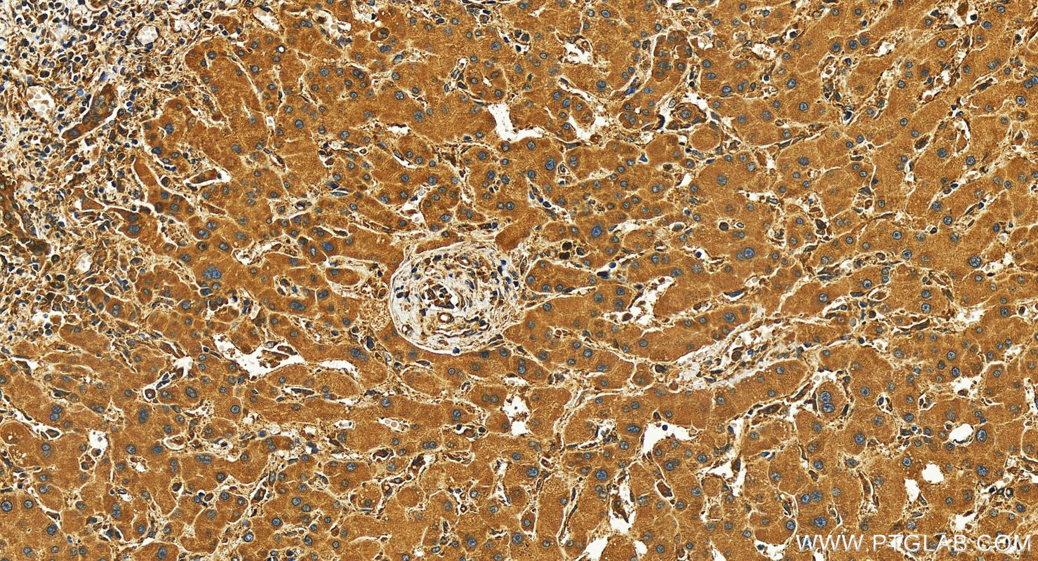 IHC staining of human intrahepatic cholangiocarcinoma using 82960-5-RR