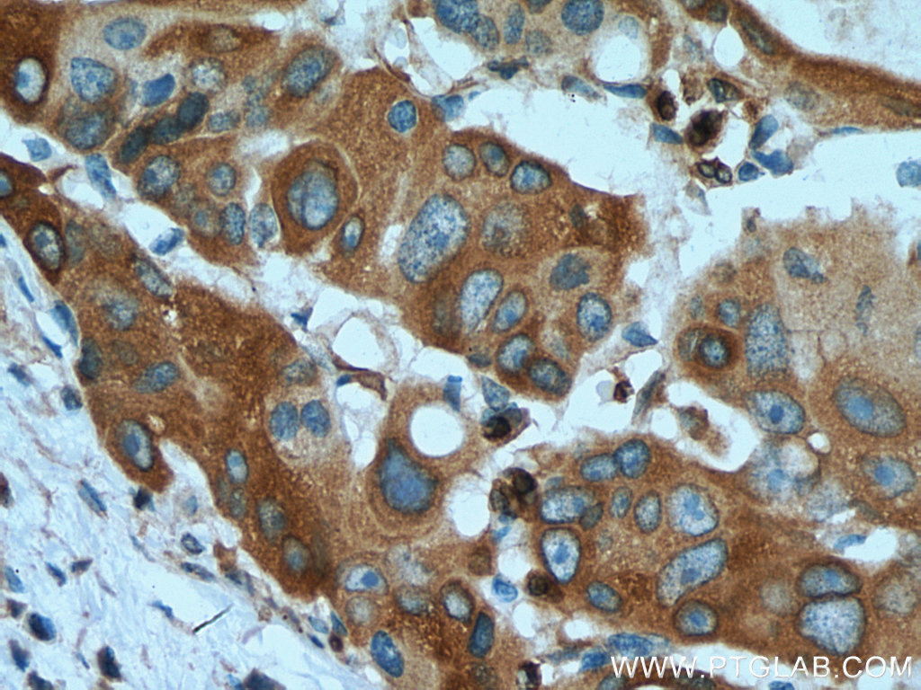 IHC staining of human colon cancer using 67118-1-Ig (same clone as 67118-1-PBS)