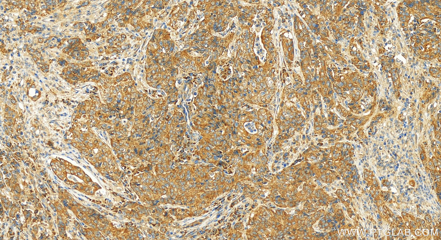 IHC staining of human stomach cancer using 12321-1-AP