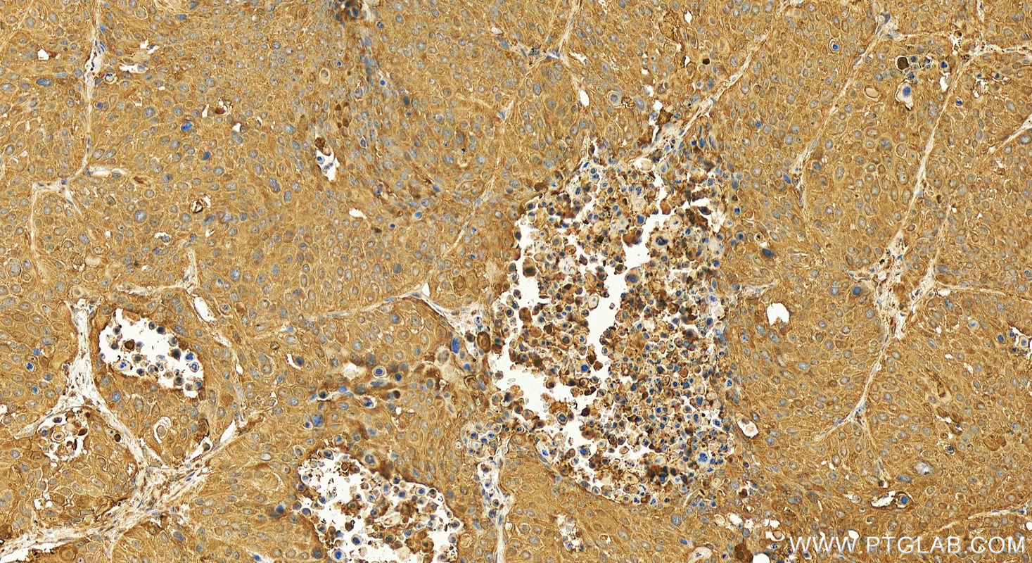 IHC staining of human lung squamous cell carcinoma using 10213-2-AP