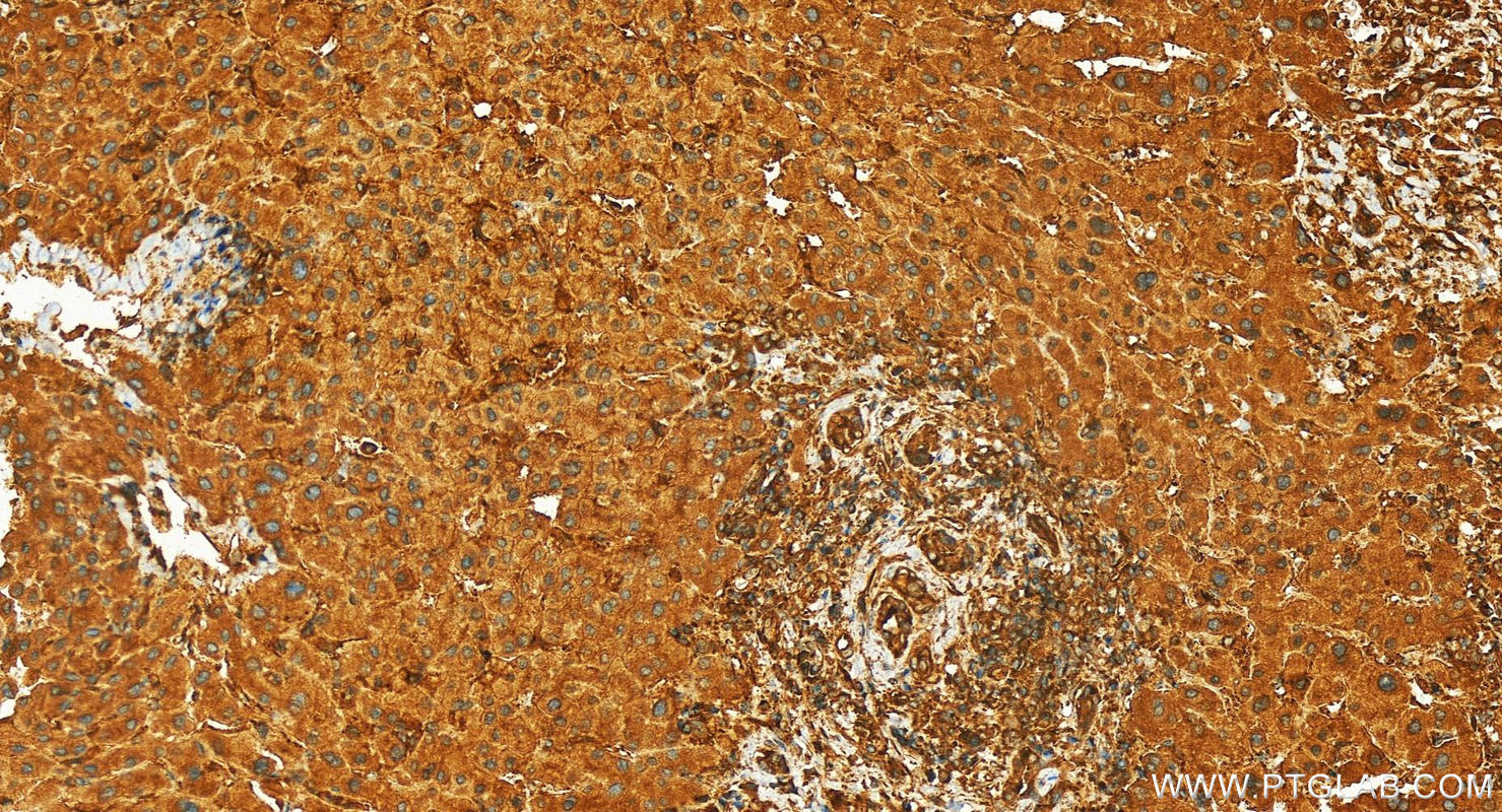 IHC staining of human intrahepatic cholangiocarcinoma using 14223-1-AP