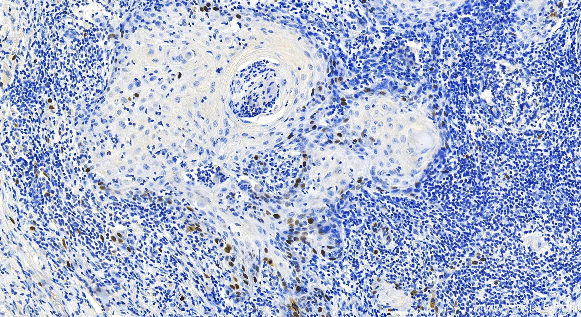 IHC staining of human skin cancer using 82788-1-RR